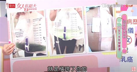 乳暈黑點